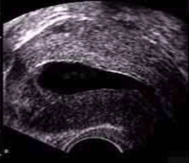 Ultrasonido de seguimiento folicular